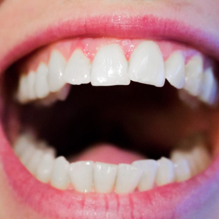 Smiling patient after a fluoride treatment