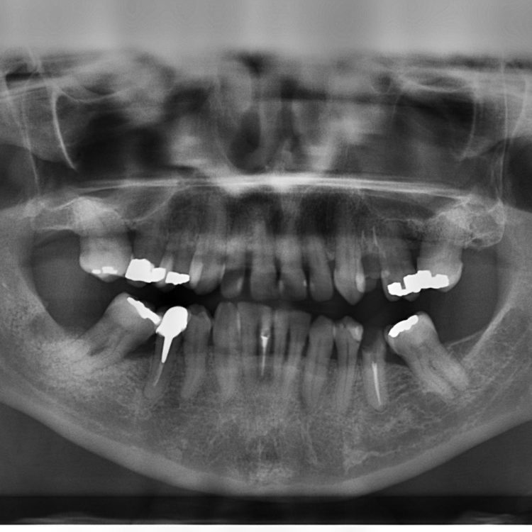 X-Ray of the inside of a patient's mouth