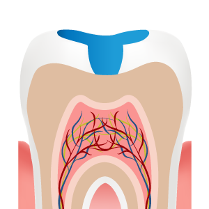 Illustration of an inlay