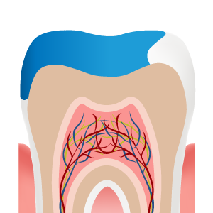 Illustration of an onlay