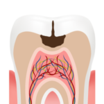 Illustration of a filling, step 1