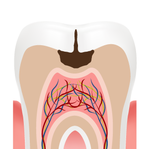 Illustration of a filling, step 1