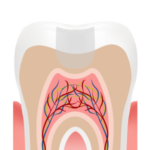 Illustration of a filling, step 2