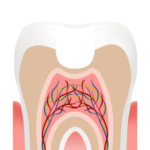 Illustration of a filling, step 3