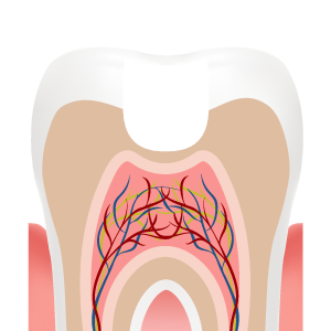 Illustration of a filling, step 3